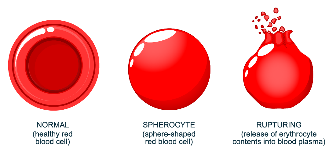 Picture of haemolysis