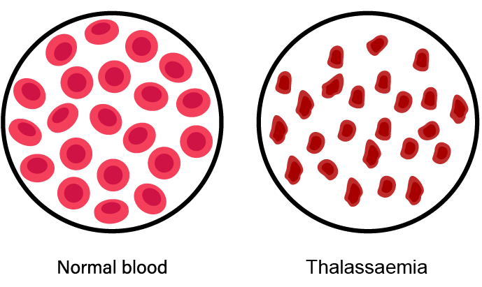 normal red cell vs Thalassaemia
